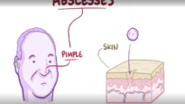 Abscesses causes, symptoms, diagnosis, treatment, pathology