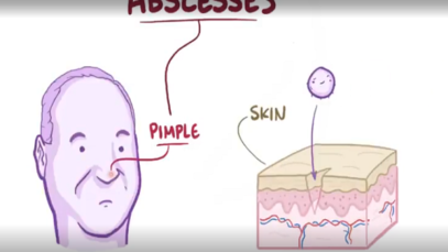 Abscesses causes, symptoms, diagnosis, treatment, pathology