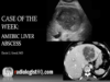 Amebic Liver Abscess (Ultrasound CT)