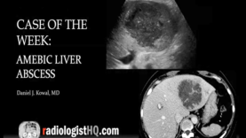 Amebic Liver Abscess (Ultrasound CT)