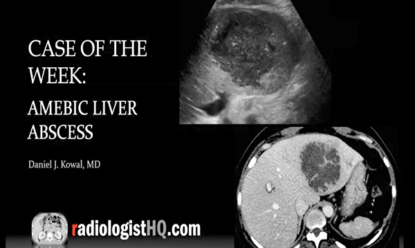 Amebic Liver Abscess (Ultrasound CT)