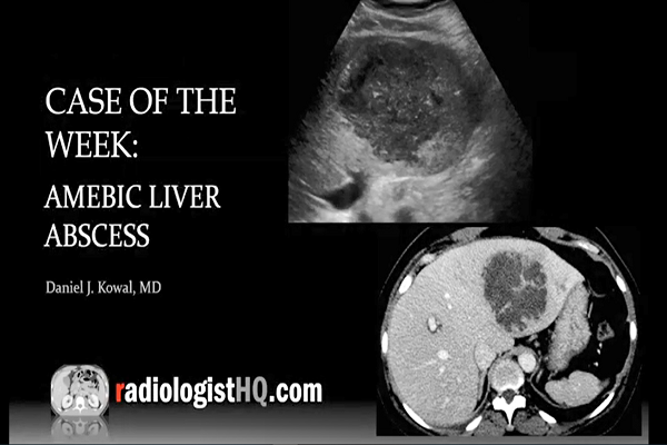 Amebic Liver Abscess (Ultrasound CT)