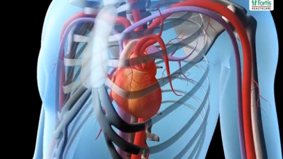 Angioplasty Procedure
