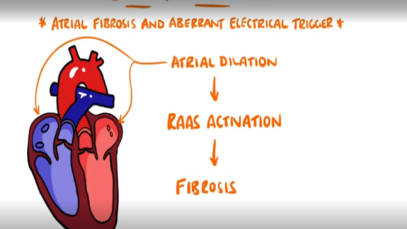 Atrial Fibrillation