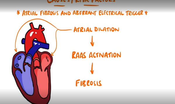 Atrial Fibrillation