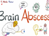 Brain Abscess Causes, Symptoms, Diagnosis, and Treatment