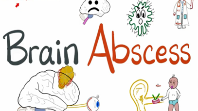 Brain Abscess Causes, Symptoms, Diagnosis, and Treatment