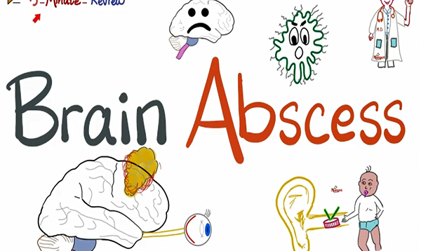 Brain Abscess Causes, Symptoms, Diagnosis, and Treatment
