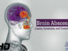 Brain Abscess Unveiled Causes, Symptoms, and Lifesaving Treatme