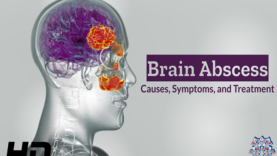 Brain Abscess Unveiled Causes, Symptoms, and Lifesaving Treatme