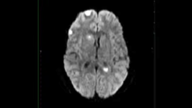 Brain Abscesses, multiple