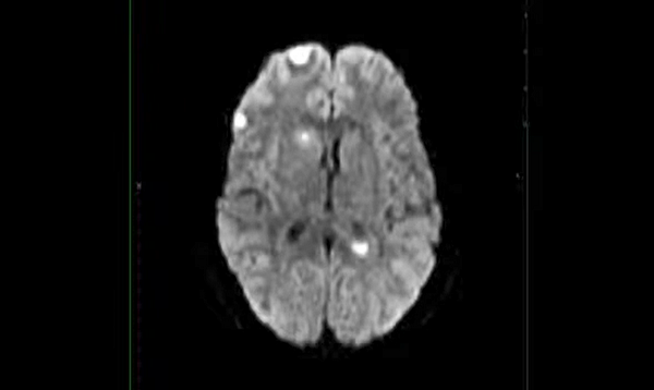 Brain Abscesses, multiple