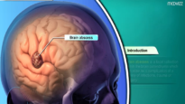 Brain abscess Pathology Etiology , Pathogenesis