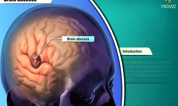 Brain abscess Pathology Etiology , Pathogenesis