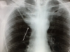 Clinical Case Pulmonary Abscess