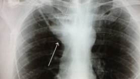 Clinical Case Pulmonary Abscess