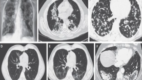Cryptogenic Organizing Pneumonia (COP)
