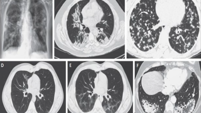 Cryptogenic Organizing Pneumonia (COP)