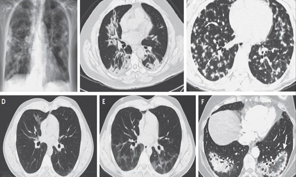 Cryptogenic Organizing Pneumonia (COP)