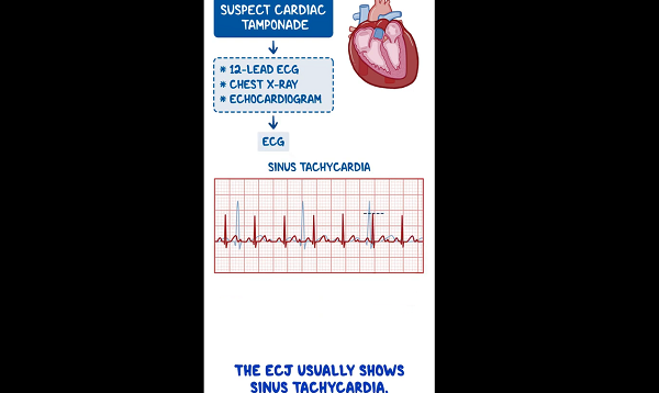 Diagnostics on Demand Cardiac tamponade