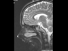 How to read an MRI of the brain