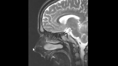 How to read an MRI of the brain