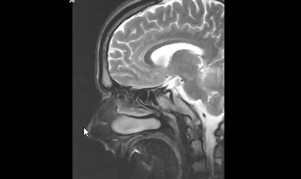How to read an MRI of the brain