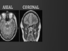 Introduction to MRI of the brain