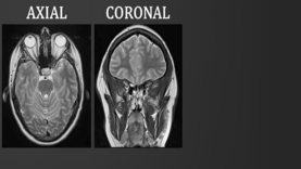 Introduction to MRI of the brain