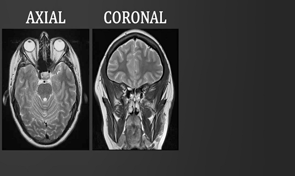 Introduction to MRI of the brain