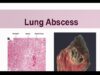 Lung Abscess