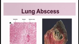 Lung Abscess