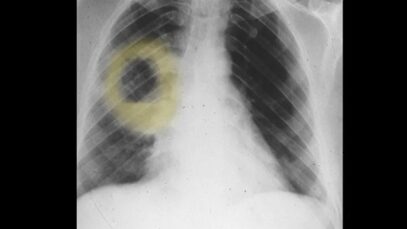 Lung Abscess Explanation of Chest X-ray Findings