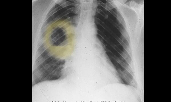 Lung Abscess Explanation of Chest X-ray Findings