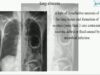 Lung Abscess1