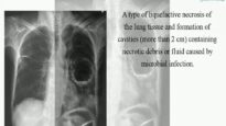 Lung Abscess1