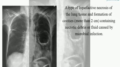 Lung Abscess1