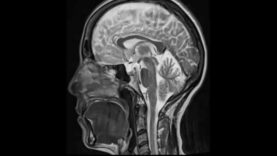 MS white matter lesions First Look MRI