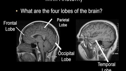 Normal Brain MRI Anatomy