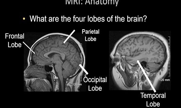 Normal Brain MRI Anatomy