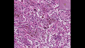 Organizing pneumonia