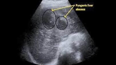 Pyogenic Liver Abscess
