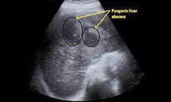 Pyogenic Liver Abscess
