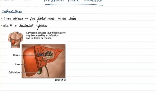 Pyogenic Liver Abscess – General Surgery