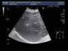 Ultrasound Video showing Amoebic liver abscess