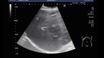Ultrasound Video showing Amoebic liver abscess