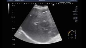Ultrasound Video showing Amoebic liver abscess