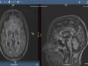 Understand Your Scan MS MRI and Brain Atrophy