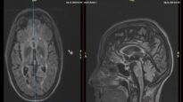 Understand Your Scan MS MRI and Brain Atrophy