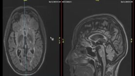 Understand Your Scan MS MRI and Brain Atrophy